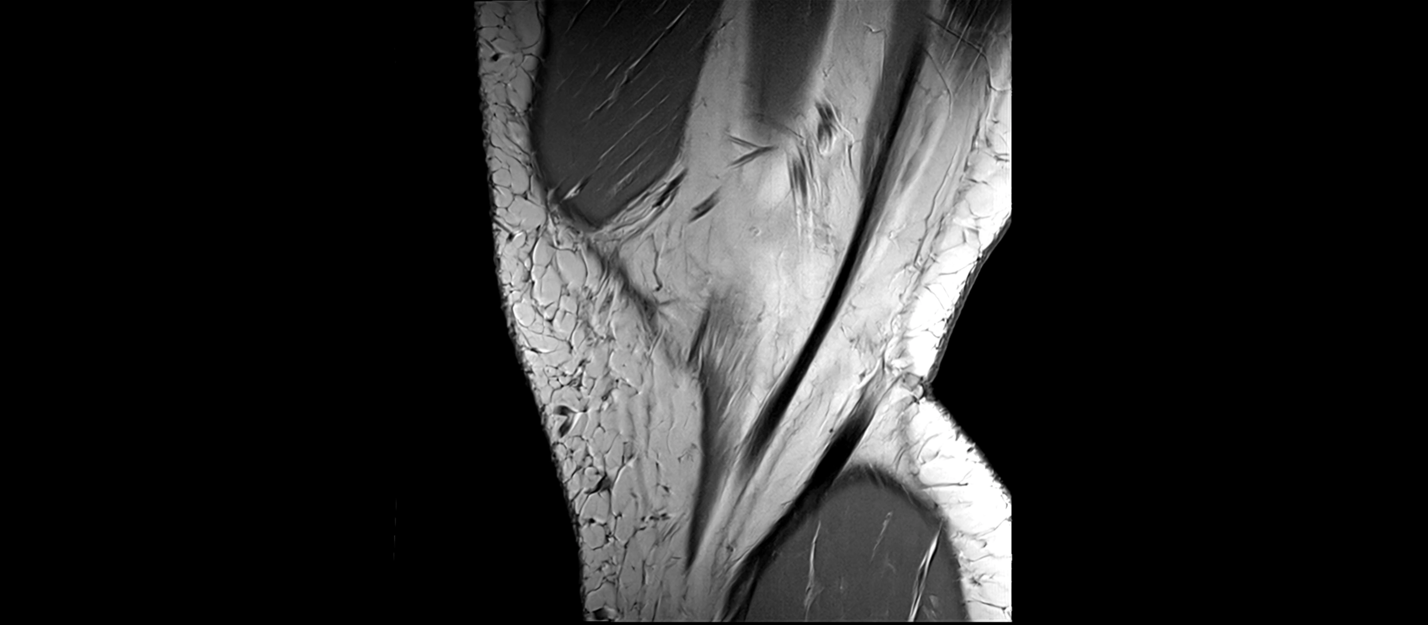 MRI sagittal  ligaments cross sectional anatomy 3T  radiology  image-img-00001-00006.webp